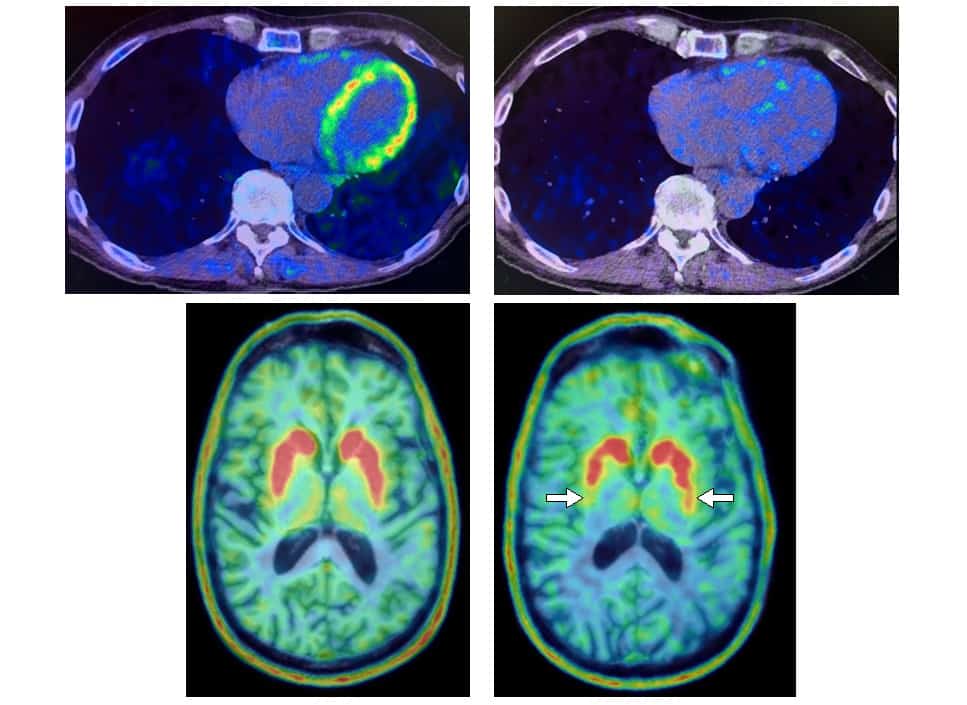Heart and brain PET scans from a study participant who developed Parkinson’s disease