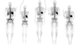 Total-body immunoPET images