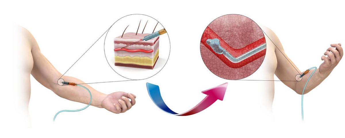 The variable stiffness P-CARE intravenous needle