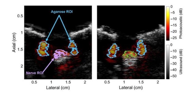 Nerves Photoacoustic images of the ulnar and median nerves from a pig